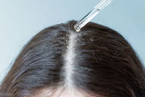 Dandruff Therapy