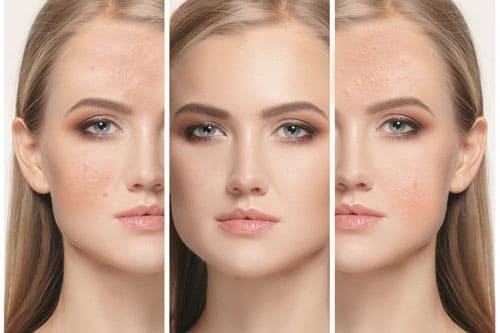 Fractional Laser for Pimple Scars