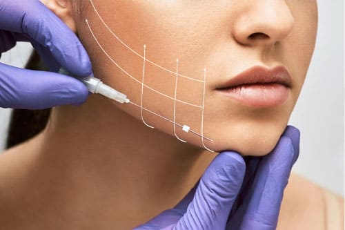 Thread Lift