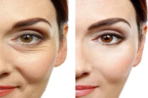 Botox