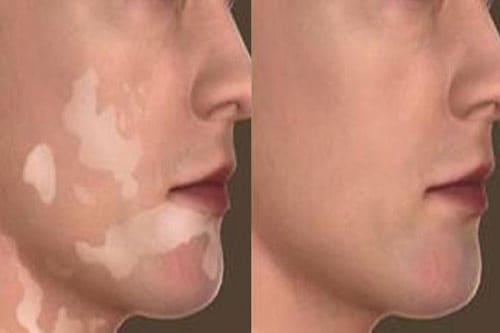 Vitiligo Grafting