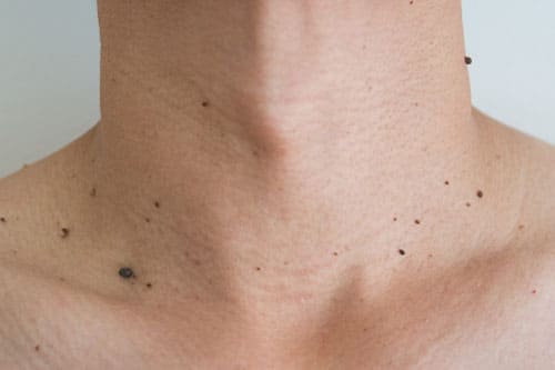 Mole Excision